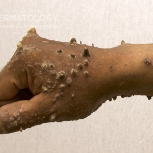 Keratosis Lichenoides Chronica_C_hand1.jpg