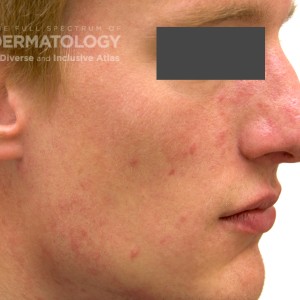 Rosacea_A_Profile_2.jpg