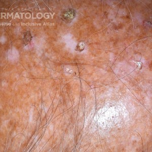 Actinic_Keratosis_5_C_JDD.jpg