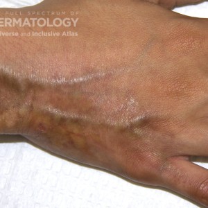 morphea_c_carrington_hand2.jpg