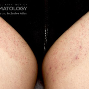 Tinea_corporis_thigh_b.jpg