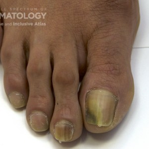 Onychomycosis_D_Foot_3.jpg