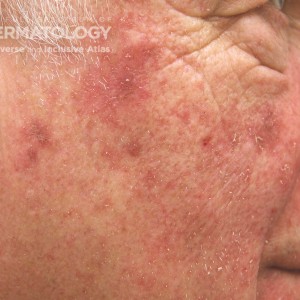 Actinic_Keratosis_3_B_Adusumilli13.jpg