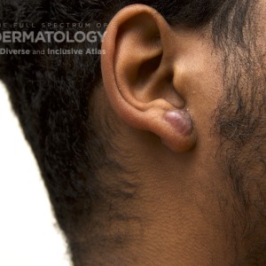 keloid_D_Ear1.jpg