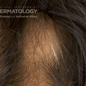 Alopecia Areata_C_8.jpg