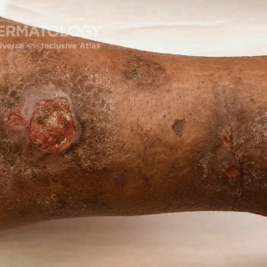 Venous Leg Ulcer_1_D_2.jpg