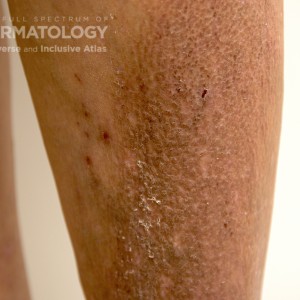 Macularamyloidosis_c_leg4.jpg