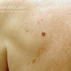 Seborrheic_keratosis_B_3.jpg