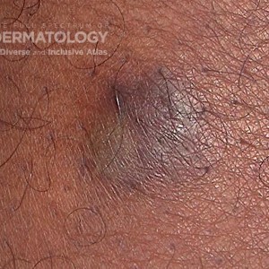 Dermatofibroma_E_56273.jpg