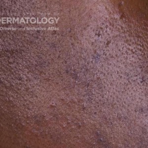 Folliculitis_E_ 58140.jpg