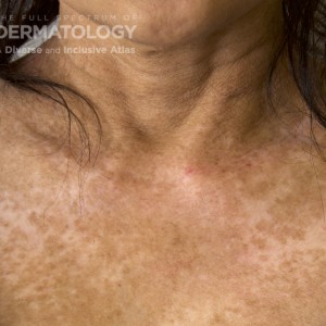 Dermatomyositis_B_Carrington7.jpg