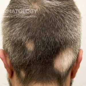 AlopeciaAreata_B_Back.jpg