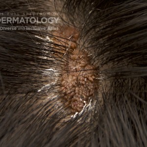 Epidermalnevi_b_scalp.jpg