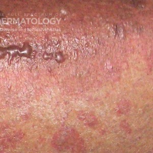 Leukocytoclastic Vasculitis_type D_Closeup.jpg