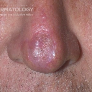 Actinic_Keratosis_4_B_2.jpg