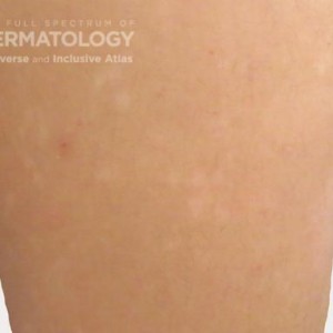 hypopigmentation leg type c_.jpg