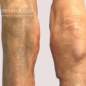 Drug Reaction_Minocycline Hyperpigmentation 3 pretibial pigmentation_Friedman.jpg