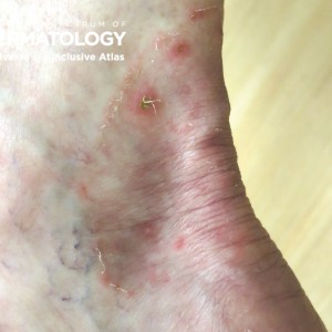 tinea pedis type A_Ankle_1.jpg