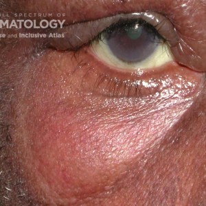 Dermatomyositis_DIR56312.jpg