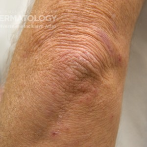 AtopicDermatitis_B_Adusumilli_Elbow.jpg