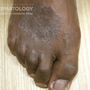 tinea pedis type E.jpg