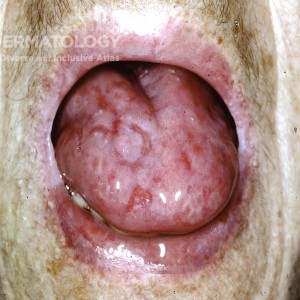 Pemphigus Vulgaris_B_Tongue_Cohen.jpg