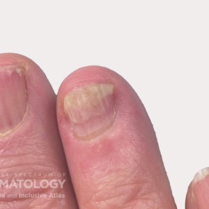 Psoriasis_nails_ DIR56240_.jpg