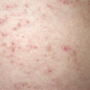 Keratosis follicularis_A_Closeeup.jpg