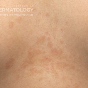 Tinea_versicolor_A_3.jpg