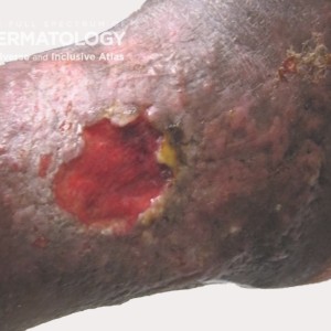 Venous Leg Ulcer_2 d-e_.jpg