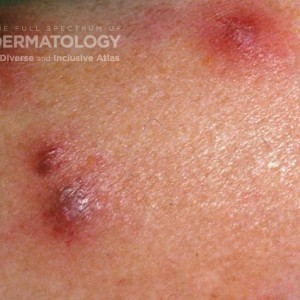 Acute Febrile Neutrophilic Dermatosis_ DIR56195.jpg