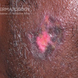 Discoid Lupus Erythematosus_E_ 60185.jpg