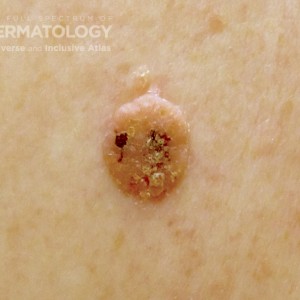 Seborrheic_keratosis_B_3_Closeup.jpg