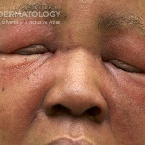 Dermatomyositis_D_Adusumilli6.jpg