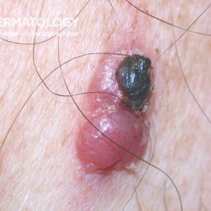 Ulcerated melanoma.jpg