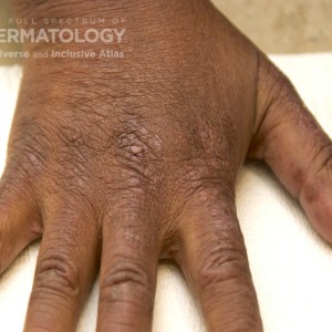 Dermatomyositis_D_Adusumilli24.jpg