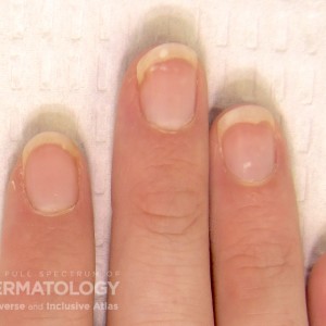 psoriaticnail_b_2_nails.jpg