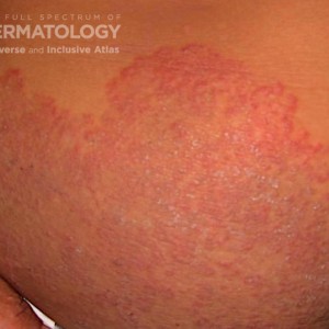 Tinea corporis_C_ 60317.jpg