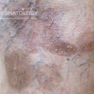 bullous pemphigoid changes type C.jpg