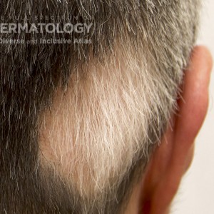 AlopeciaAreata_B_Closeup.jpg