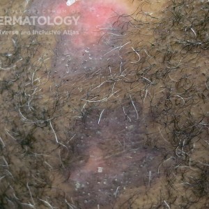 Discoid_Lupus_Erythematosus type E scalp_closeup.jpg