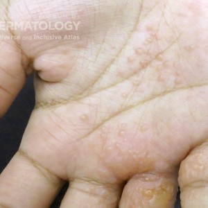 dyshidrotic eczema type B.jpg