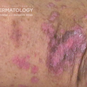 lichen planus type c.jpg