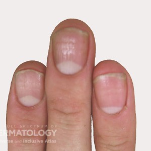 Psoriatic_with nail pits type b_.jpg