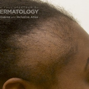 Traction Alopecia_Hairline_E_11.jpg