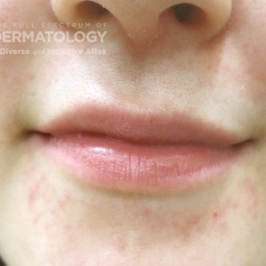 perioral dermatitis type b.jpg