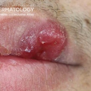 Pyogenic granuloma_B_JDD_Lip.jpg