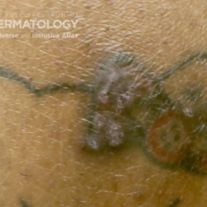 lichen planus in tattoo type d.jpg