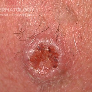 Squamous Cell Carcinoma_B_Face.jpg