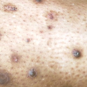 prurigo nodularis with hypopigmentation tyoe D leg.jpg